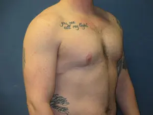 Gender Affirming Male Before and After Pictures in St. Louis, MO