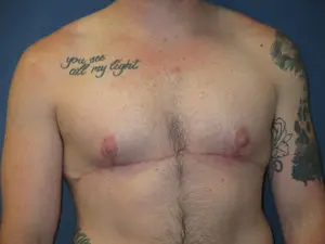 Gender Affirming Male Before and After Pictures in St. Louis, MO