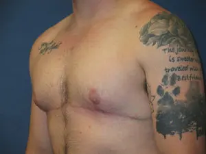 Gender Affirming Male Before and After Pictures in St. Louis, MO