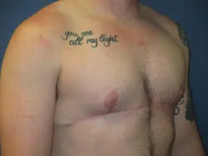 Gender Affirming Male Before and After Pictures in St. Louis, MO