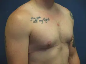 Gender Affirming Male Before and After Pictures in St. Louis, MO