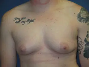 Gender Affirming Male Before and After Pictures in St. Louis, MO