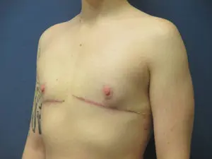 Gender Affirming Male Before and After Pictures in St. Louis, MO