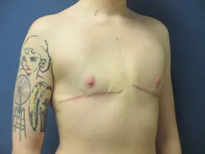 Gender Affirming Male Before and After Pictures in St. Louis, MO