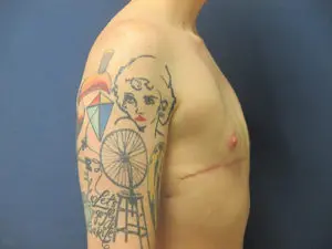 Gender Affirming Male Before and After Pictures in St. Louis, MO