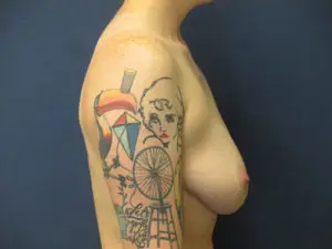 Gender Affirming Male Before and After Pictures in St. Louis, MO