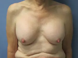 Implant Removal Before and After Pictures in St. Louis, MO