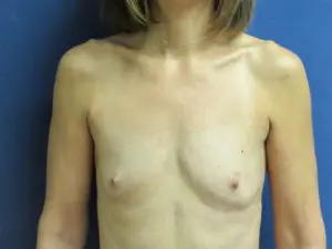 Breast Augmentation Before and After Pictures in St. Louis, MO