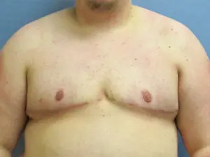 Gender Affirming Male Before and After Pictures in St. Louis, MO