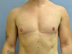 Gender Affirming Male Before and After Pictures in St. Louis, MO