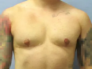 Gender Affirming Male Before and After Pictures in St. Louis, MO