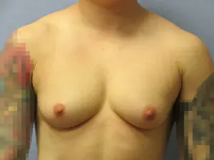 Gender Affirming Male Before and After Pictures in St. Louis, MO