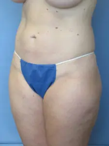 Liposuction Before and After Pictures St. Louis, MO