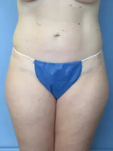 Liposuction Before and After Pictures St. Louis, MO