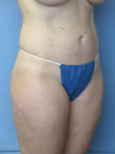 Liposuction Before and After Pictures St. Louis, MO