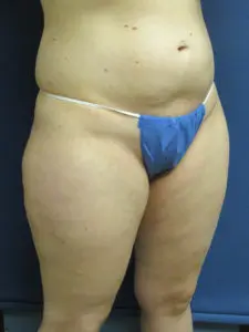 Liposuction Before and After Pictures St. Louis, MO