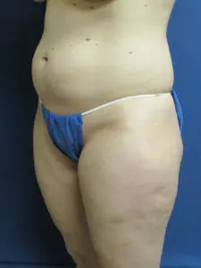 Liposuction Before and After Pictures St. Louis, MO