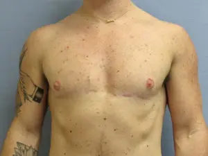 Gender Affirming Male Before and After Pictures in St. Louis, MO