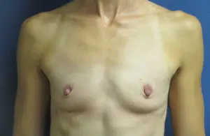 Breast Augmentation Before and After Pictures in St. Louis, MO