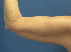 CoolSculpting® Before and After Pictures St. Louis, MO