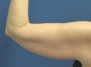 CoolSculpting® Before and After Pictures St. Louis, MO