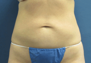 CoolSculpting® Before and After Pictures St. Louis, MO