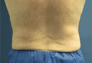 CoolSculpting® Before and After Pictures St. Louis, MO