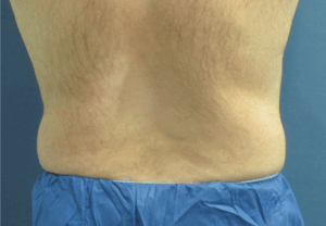CoolSculpting® Before and After Pictures St. Louis, MO