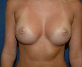 Breast Augmentation Before and After Pictures St. Louis, MO