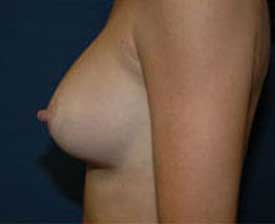 Breast Augmentation Before and After Pictures St. Louis, MO