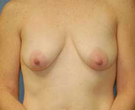 Breast Augmentation Before and After Pictures St. Louis, MO