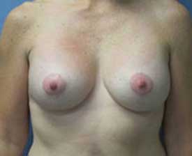 Breast Augmentation Before and After Pictures St. Louis, MO
