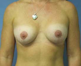 Breast Augmentation Before and After Pictures St. Louis, MO