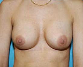 Breast Augmentation Before and After Pictures St. Louis, MO