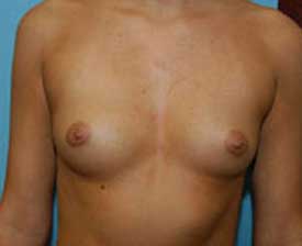 Breast Augmentation Before and After Pictures St. Louis, MO