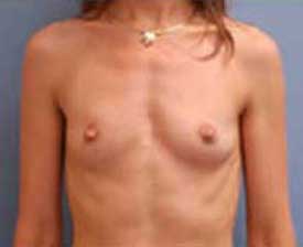 Breast Augmentation Before and After Pictures St. Louis, MO