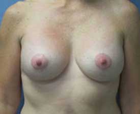 Breast Lift Before and After Pictures St. Louis, MO