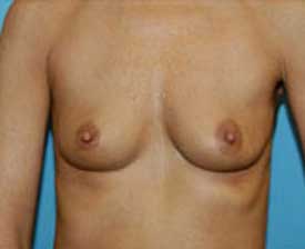 Breast Augmentation Before and After Pictures St. Louis, MO