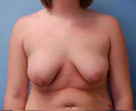 Breast Lift Before and After Pictures St. Louis, MO