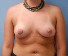 Breast Lift Before and After Pictures St. Louis, MO