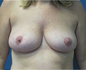 Breast Lift Before and After Pictures St. Louis, MO