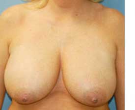 Breast Reduction Before and After Pictures St. Louis, MO