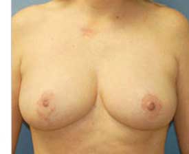 Breast Reduction Before and After Pictures St. Louis, MO