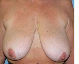 Breast Reduction Before and After Pictures St. Louis, MO