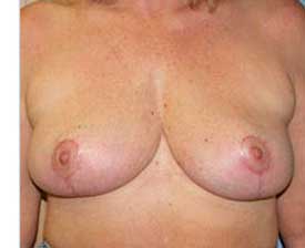 Breast Reduction Before and After Pictures St. Louis, MO