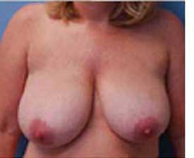 Breast Reduction Before and After Pictures St. Louis, MO