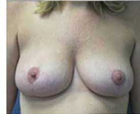 Breast Reduction Before and After Pictures St. Louis, MO