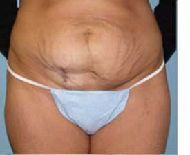 Tummy Tuck Before and After Pictures St. Louis, MO