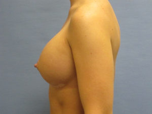 Breast Augmentation Before and After Pictures St. Louis, MO