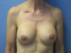 Breast Augmentation Before and After Pictures St. Louis, MO